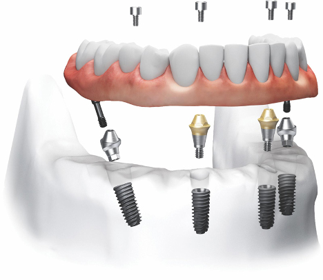 Implant