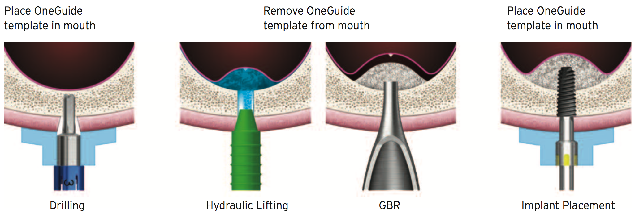 OneCAS KIT accurate drilling and safe implantation